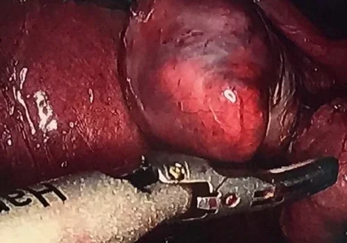 A 30mm right ovarian endometrioma which is adherent to the right side wall, posterior cervix and right utero-sacral ligament