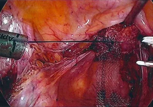 A Laparoscopic Hysterectomy has been performed. The mesh is now sutured laparoscopically to the cervical stump