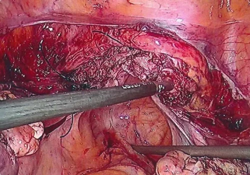 A Total Laparoscopic Hysterectomy has been performed. The vault has been sutured. Two normal ovaries are seen on either side of the vault.