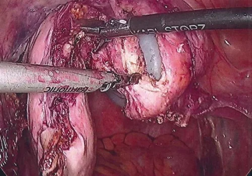A Total Laparoscopic Hysterectomy has been performed. This demonstrates the final part of detaching the uterus from the vagina (colpotomy)