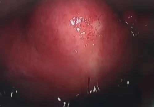 A large uterus - fibroids and adenomyosis.
