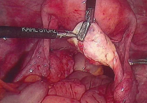 A left Ovarian Cystectomy is performed. The left para-tubal cyst is also removed