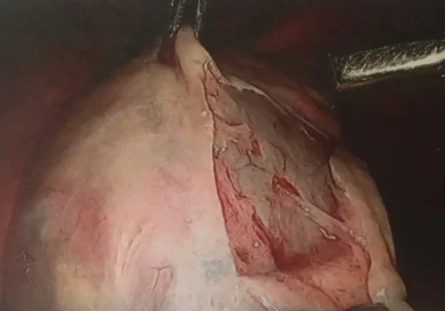 A left ovarian cystectomy is performed. Normal left ovarian tissue is preserved.