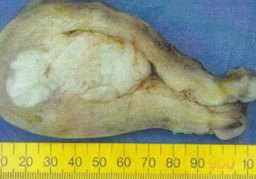 A photograph of the uterus showing a large fibroid which had grown into the cavity.