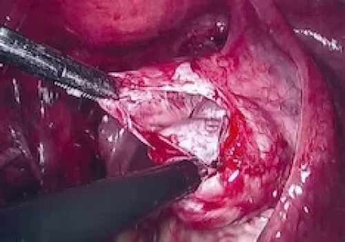 A smaller right ovarian cyst is removed to leave a normal right ovary