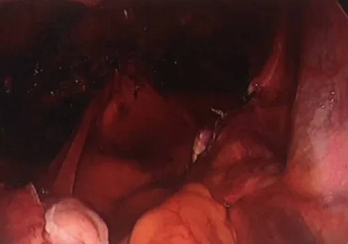 A view of the pelvis taken further back -to demonstrate normal ovaries.
