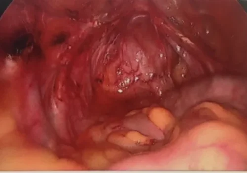 All bowel adhesions have been divided. A normal pelvis.