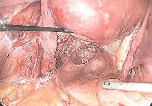 All visible endometriosis has been excised