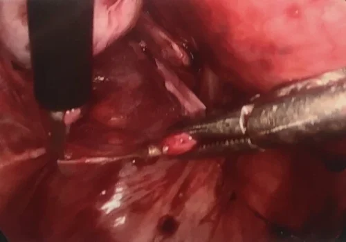 All visible endometriosis is excised.