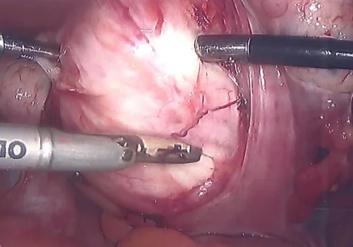 An incision is made over the fibroid capsule.