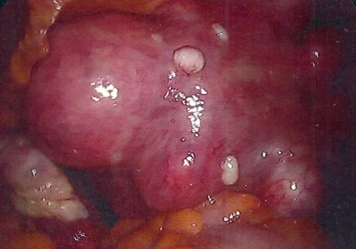 Another view of large multi-fibroid uterus
