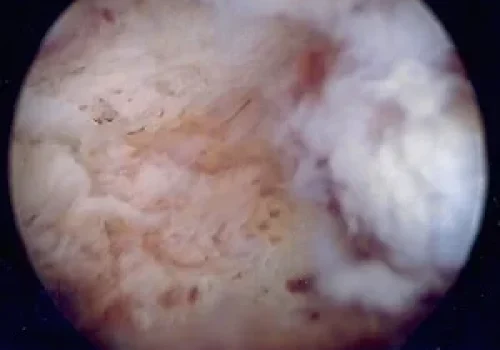Appearance of cavity of uterus after novasure endometrial ablation
