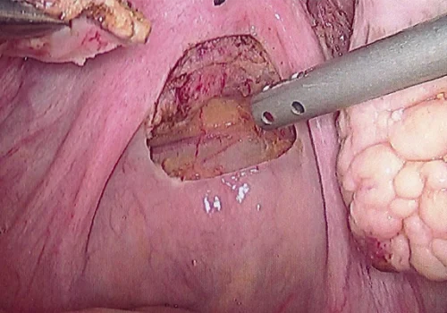 Appearance of the Pouch of Douglas after endometriosis has been excised