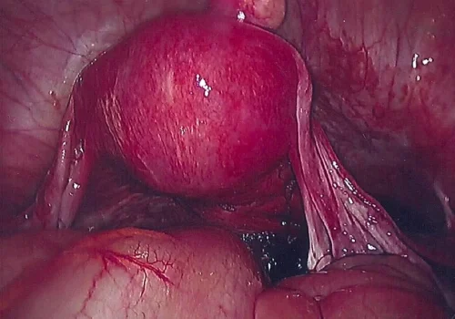 At the end of the operation