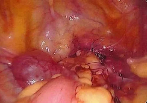 At the end of the operation. The mesh has been tacked to the Sacral Promontory
