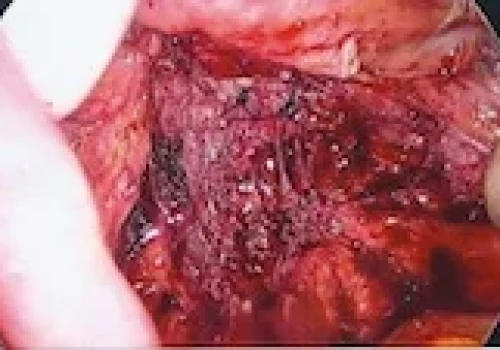 At the end of the operation. This shows the area behind the uterus where the endometriosis has been completely removed. This is a close-up picture
