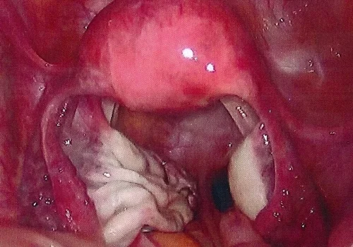 At the end of the procedure. The left ovary will continue to heal