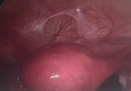 Bladder endometriosis is excised.