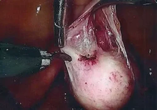 Bladder reflected from the vagina