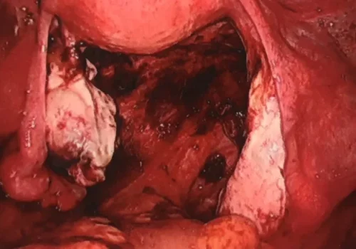 Both ureters have been dissected out and endometriosis excised from both side walls.