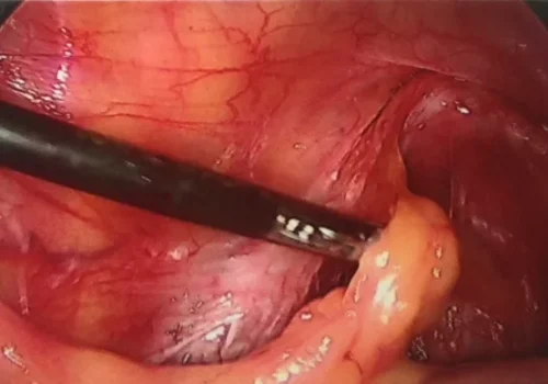 Bowel adhesions to left ovary.
