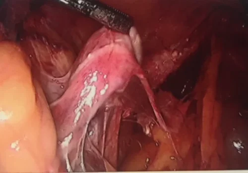 Bowel adhesions to left ovary..