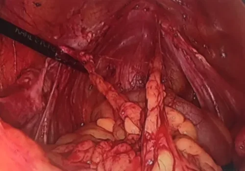Bowel adhesions to vaginal vault.