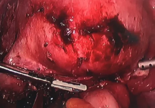 Bowel is adherent to the posterior cervix and uterus. This is Stage IV endometriosis.