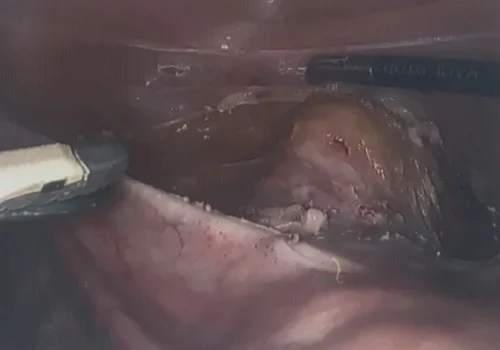 Careful dissection of the bladder - to allow attachment of the sling and high elevation of the vagina.