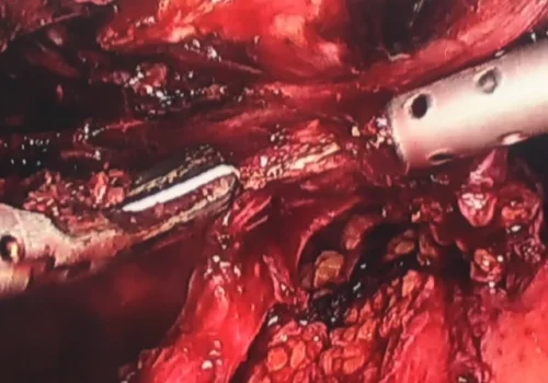 Careful dissection of the right ureter.