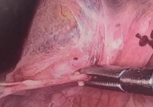 Careful excision of endometriosis - left side wall and left utero-sacral ligament.
