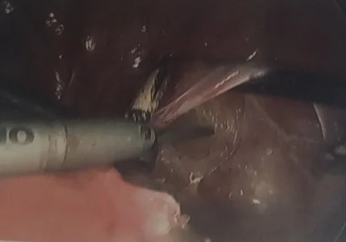 Careful mobilisation of the bladder from the anterior cervix and uterus.