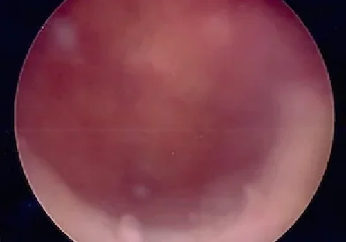 Cavity of uterus (taken at Hysteroscopy)