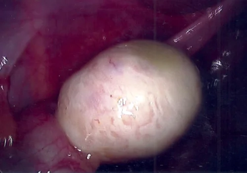 Close-up of left ovarian dermoid cyst.