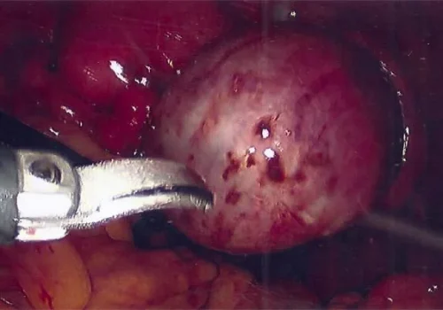 Close up of right ovarian endometrioma
