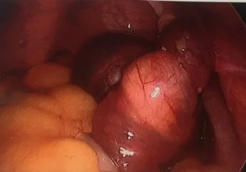 Close up showing left ovary and tube have limited blood supply (mottled appearance.)