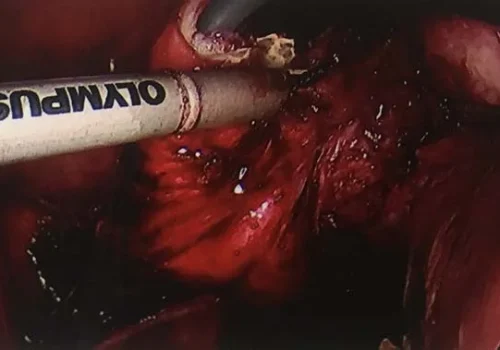 Colpotomy - to detach the uterus and cervix from the vagina.