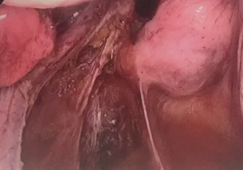 Complete excision of endometriosis - the pelvis at the end of the procedure.