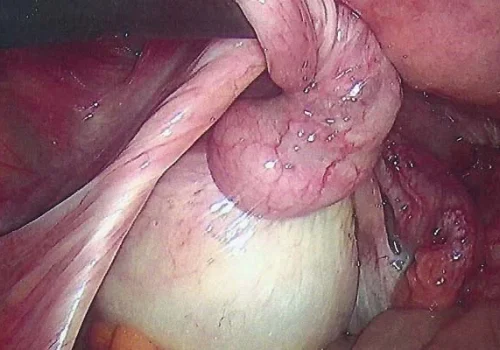Demonstrates partial torsion of the left Fallopian Tube. There is a large left Ovarian Cyst