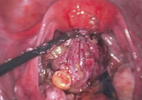 Dermoid cyst wall next to uterus. The left ovary will continue to heal and return to a normal appearance