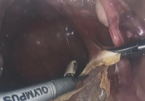 Dissection at the sacral promontory for later attachment of the sling.