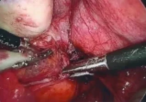 Dissection of pelvic side wall to remove all endometriosis