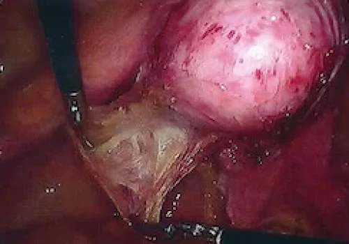 Dissection posteriorly (for later attachment of mesh)