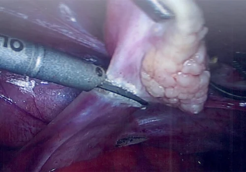 Dividing left Ovarian Vessels and removing left ovary