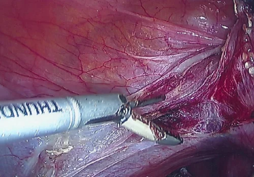 Dividing left Uterine Artery