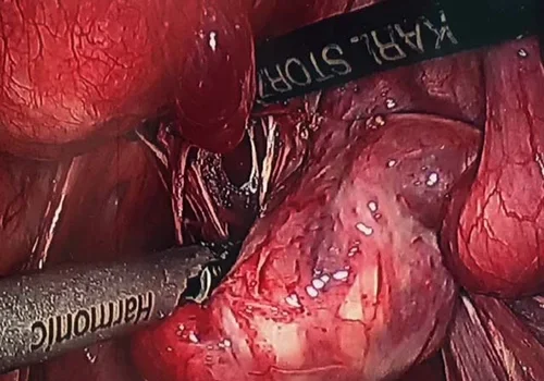Dividing the adhesions and mobilising the left ovary and tube.