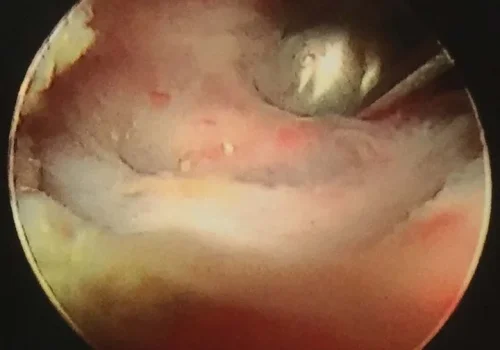 Dividing the adhesions at Hysteroscopy.