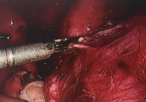 Dividing the left uterine artery.