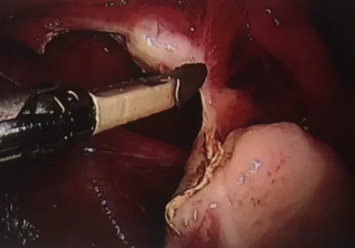 Dividing the right ovarian ligament. The right ovary is preserved.