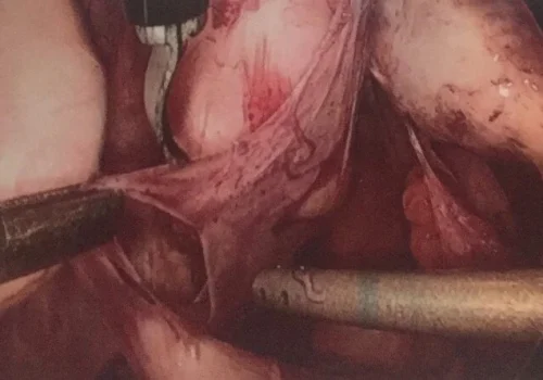 Division of adhesions.